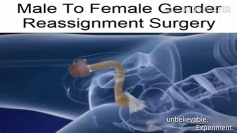 Video of Sexual Reassignment. . Srs surgery male to female